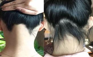 明星是怎么治疗脱发的,揭秘明星们的护发之道